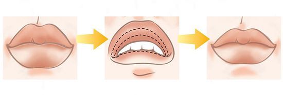 Хейлопластика (коррекция формы губ)