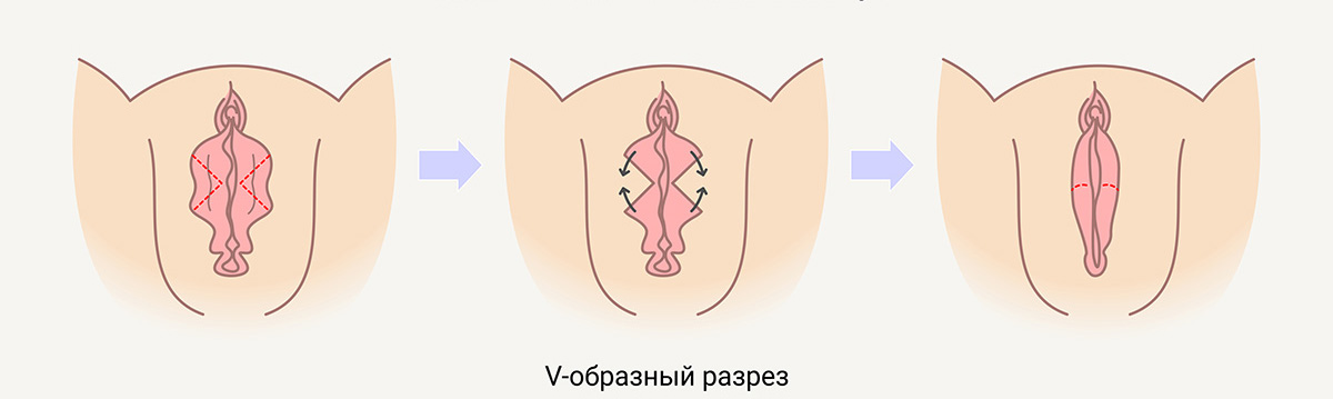 Лабиопластика в Киеве | Пластика половых губ | МЦ SENSAV
