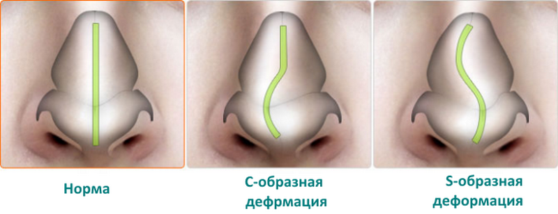 Септопластика (исправление перегородки носа)