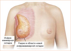 Маммопластика (увеличение груди)