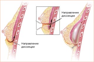 Маммопластика (увеличение груди)