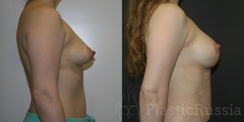 Коррекция тубулярной груди. Фото до и после. Пластический хирург Жолтиков Виталий Владимирович