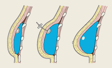 Коррекция тубулярной груди