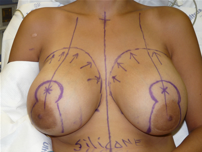 Редукционная маммопластика (уменьшение груди)