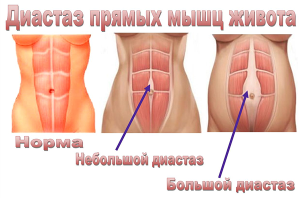 Абдоминопластика (пластика живота)