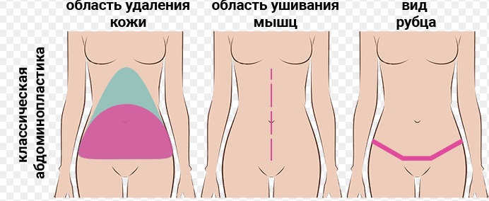 Абдоминопластика (пластика живота)