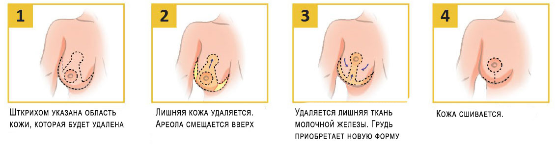 Мастопексия (подтяжка груди)