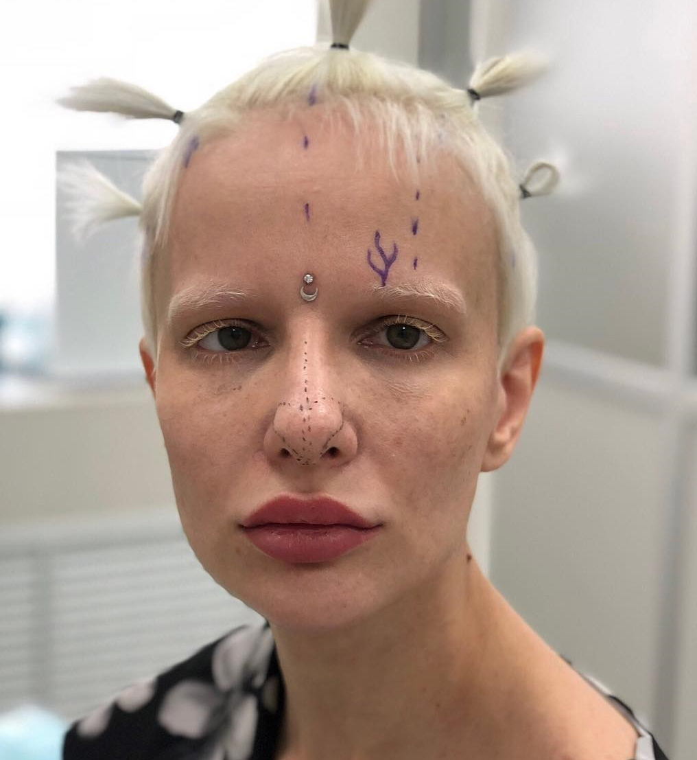 Модель-альбинос Алиса Лисс сделала ринопластику