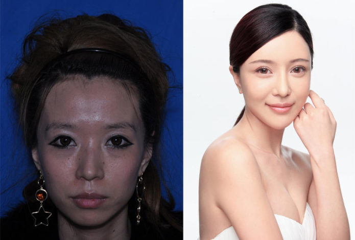 Фото китаянок до и после пластики