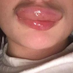 Неудачное увеличение губ