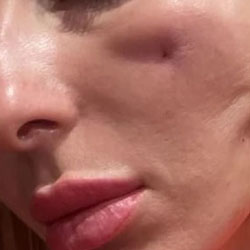 Жительница Казани пострадала от косметологической процедуры